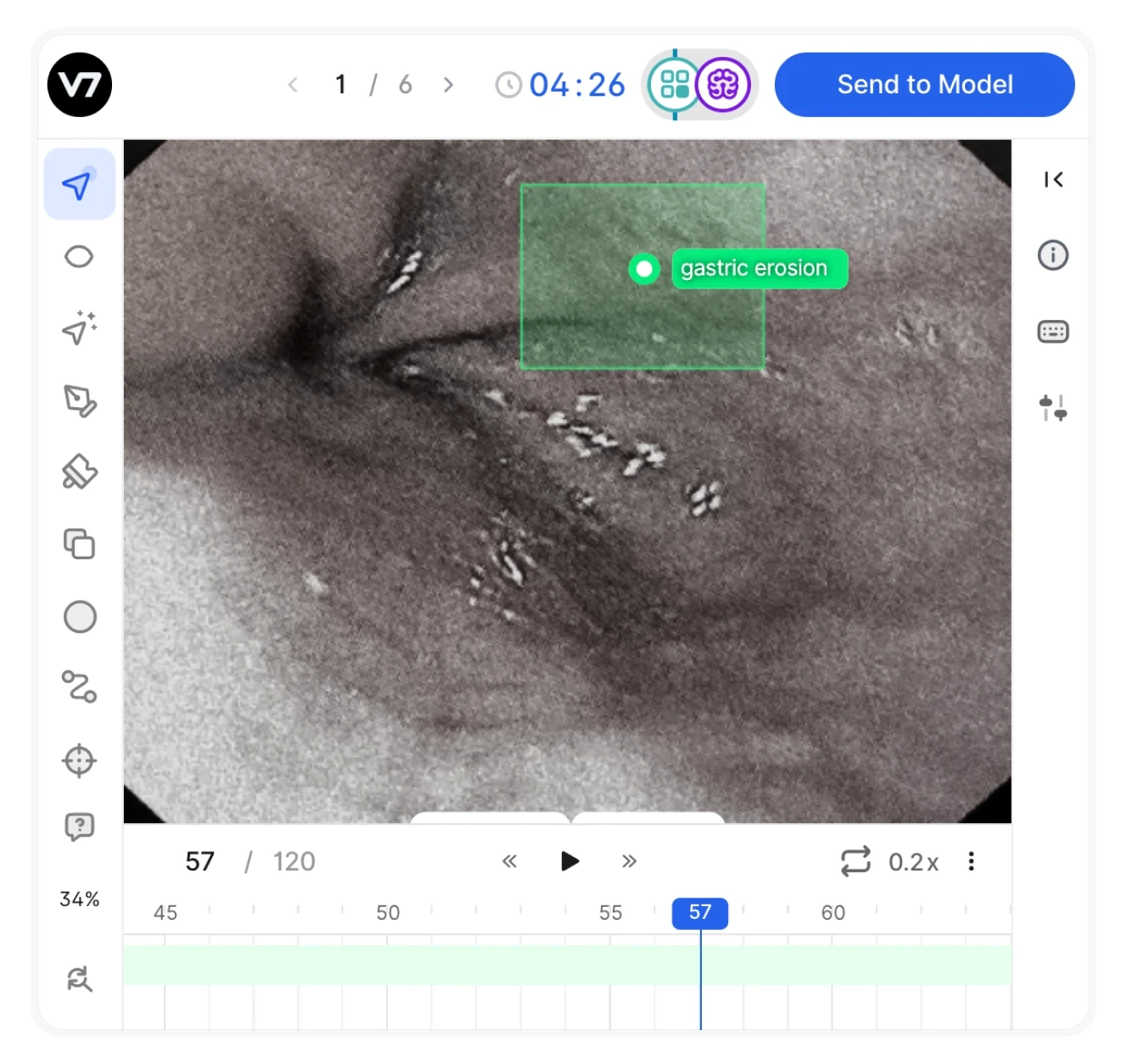 A medical AI interface analyzing an endoscopic image.