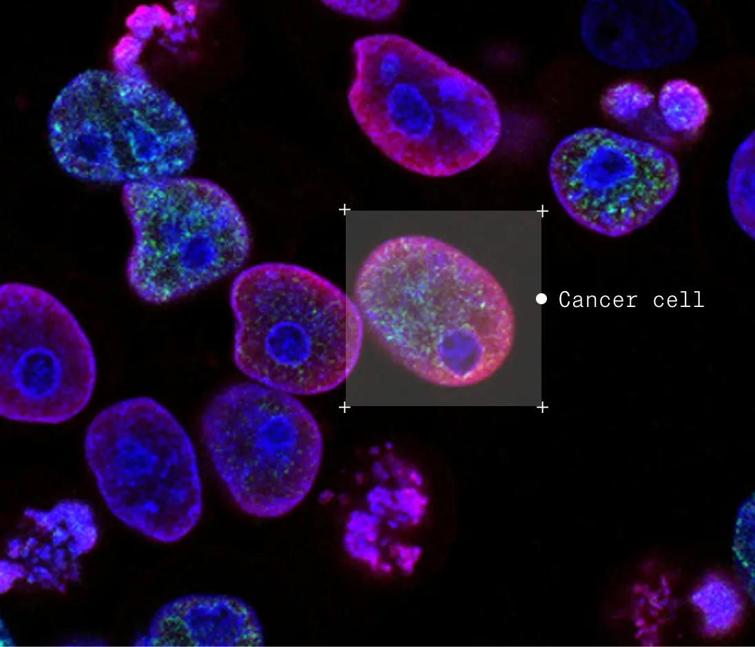 Microscopic view of cells, one labeled "Cancer cell"