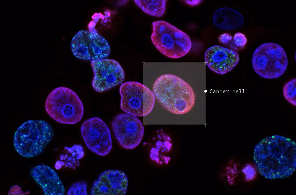 Microscopic view of cells marked "Cancer cell"